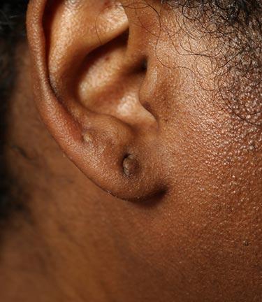 Before Results for Otoplasty
