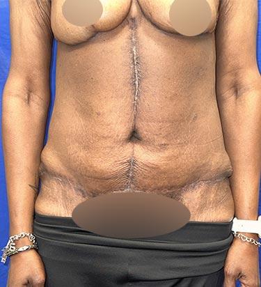 After Results for Panniculectomy