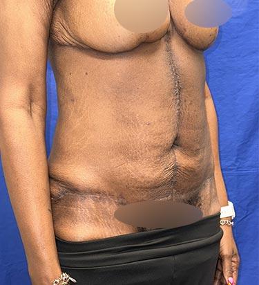 After Results for Panniculectomy