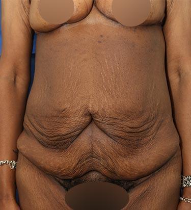 Before Results for Panniculectomy