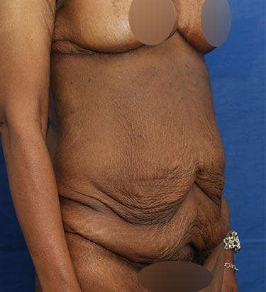 Before Results for Panniculectomy