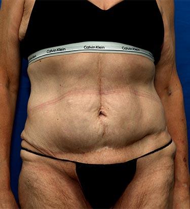 After Results for Panniculectomy