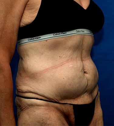 After Results for Panniculectomy