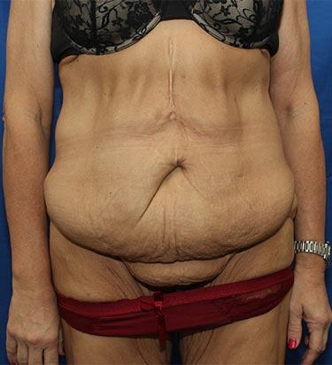 Before Results for Panniculectomy