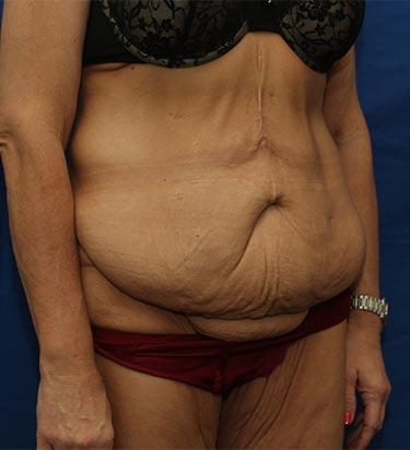 Before Results for Panniculectomy