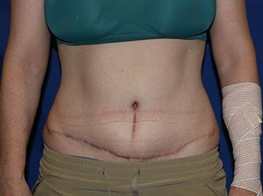 After Results for Tummy Tuck