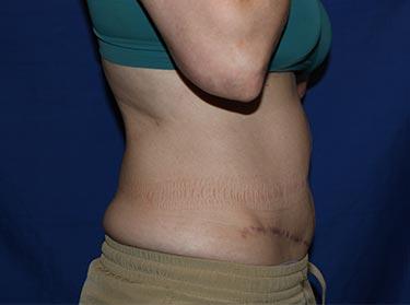 After Results for Tummy Tuck