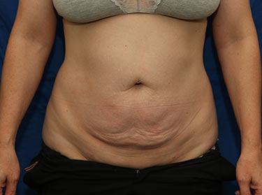 Before Results for Tummy Tuck