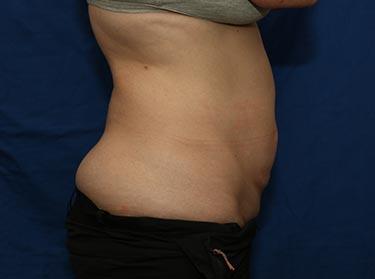 Before Results for Tummy Tuck