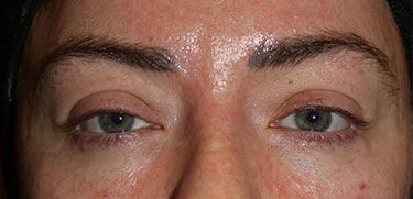 After Results for Blepharoplasty