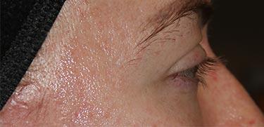 After Results for Blepharoplasty