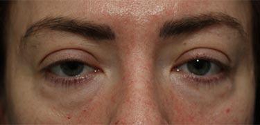 Before Results for Blepharoplasty