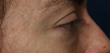 Before Results for Blepharoplasty