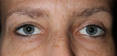 After Results for Blepharoplasty