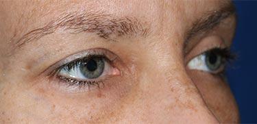 After Results for Blepharoplasty