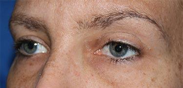 After Results for Blepharoplasty