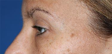 After Results for Blepharoplasty
