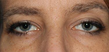 Before Results for Blepharoplasty