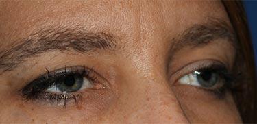 Before Results for Blepharoplasty