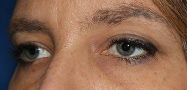 Before Results for Blepharoplasty