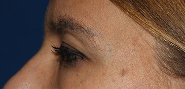 Before Results for Blepharoplasty