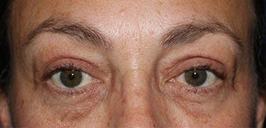 After Results for Blepharoplasty