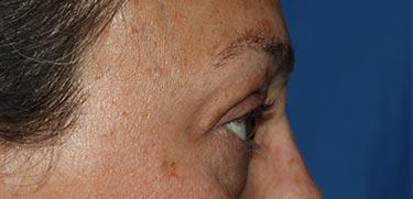 After Results for Blepharoplasty