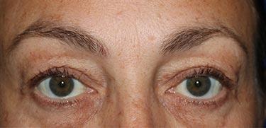 Before Results for Blepharoplasty