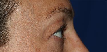 Before Results for Blepharoplasty
