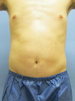 After Results for Liposuction