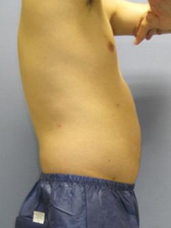 After Results for Liposuction