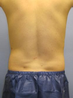 After Results for Liposuction