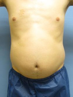 Before Results for Liposuction