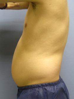 Before Results for Liposuction