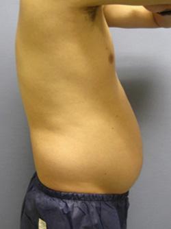 Before Results for Liposuction