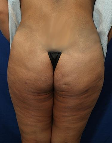After Results for Gluteal Augmentation