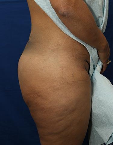 After Results for Gluteal Augmentation