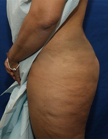 After Results for Gluteal Augmentation