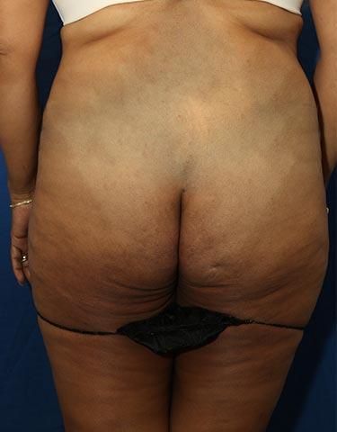 Before Results for Gluteal Augmentation