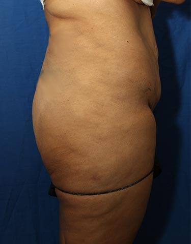 Before Results for Gluteal Augmentation