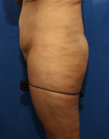 Before Results for Gluteal Augmentation