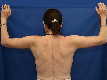 After Results for Brachioplasty / Arm Lift