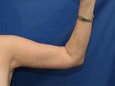 After Results for Brachioplasty / Arm Lift