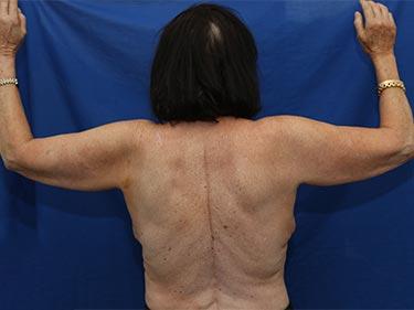 Before Results for Brachioplasty / Arm Lift