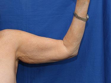 Before Results for Brachioplasty / Arm Lift