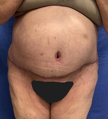 After Results for Panniculectomy
