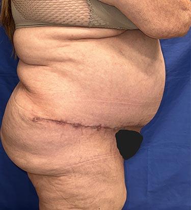 After Results for Panniculectomy
