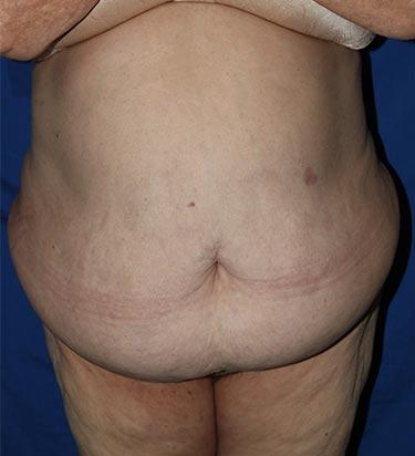 Before Results for Panniculectomy