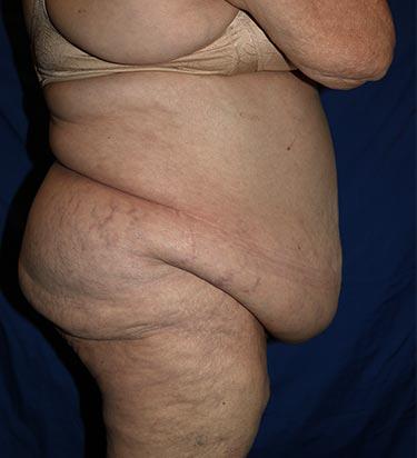 Before Results for Panniculectomy