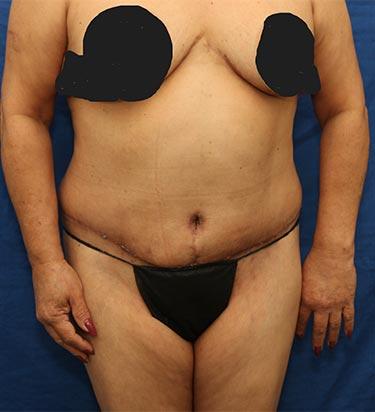 After Results for Tummy Tuck